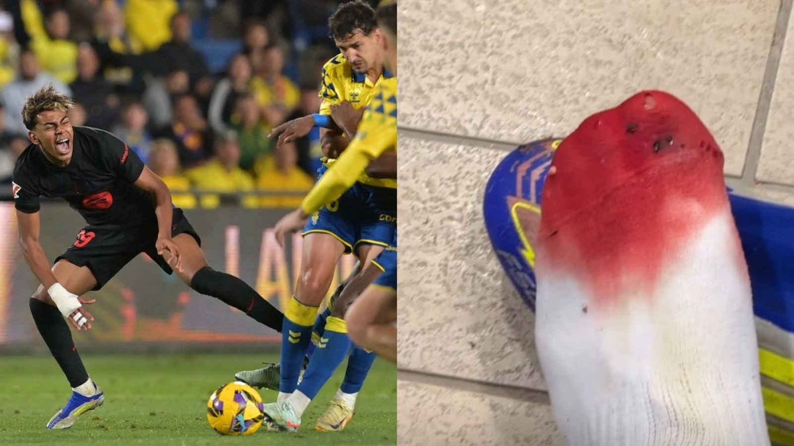 Lamine_Yamal_injury_1740299586548_1740299601767