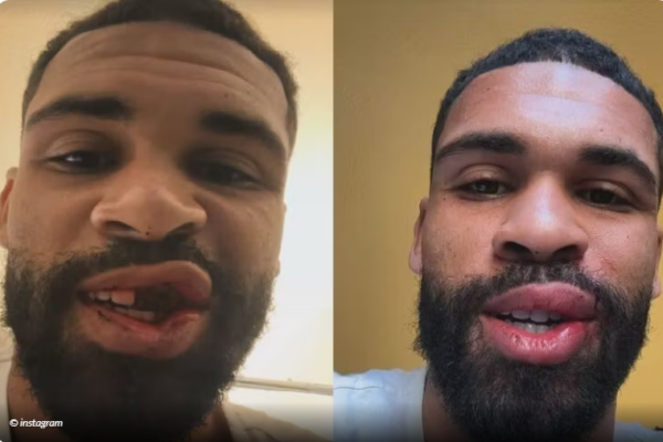 Dëmtimi i rëndë, Loftus-Cheek kalon me sukses operacionin në nofulla. Jashtë fushave për rreth 8 javë